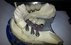 Implant dentaire - Cas de 6 implants