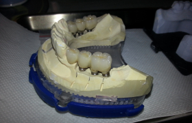 Implant dentaire - Cas de 6 implants